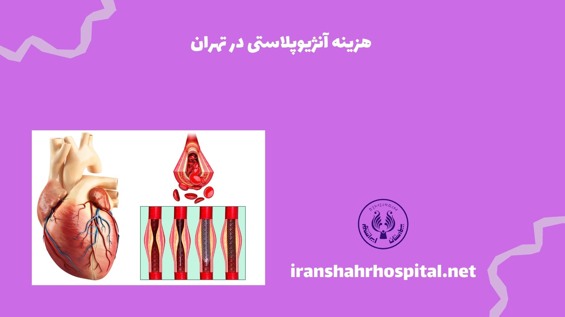 هزینه آنژیوپلاستی در تهران