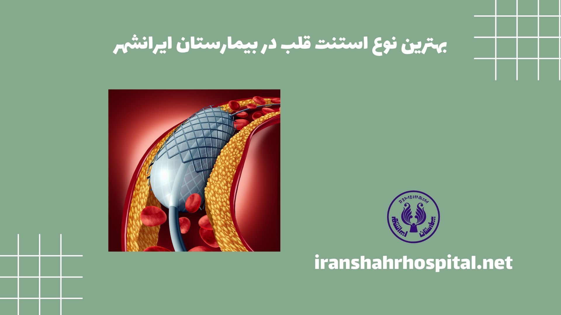 بهترین نوع استنت قلب در بیمارستان ایرانشهر