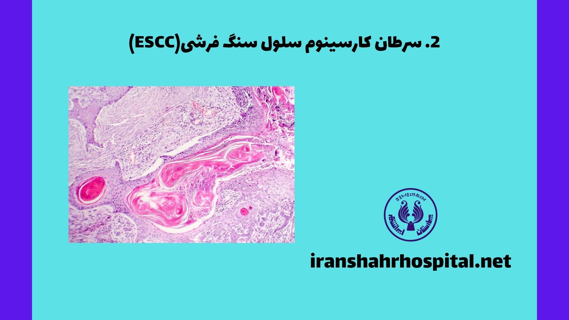 سرطان کارسینوم سلول سنگ فرشی (ESCC):