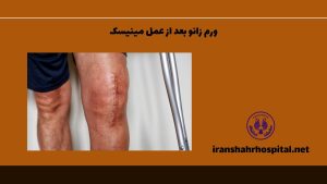 ورم زانو بعد از عمل مینیسک