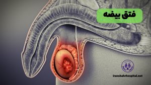 فتق بیضه