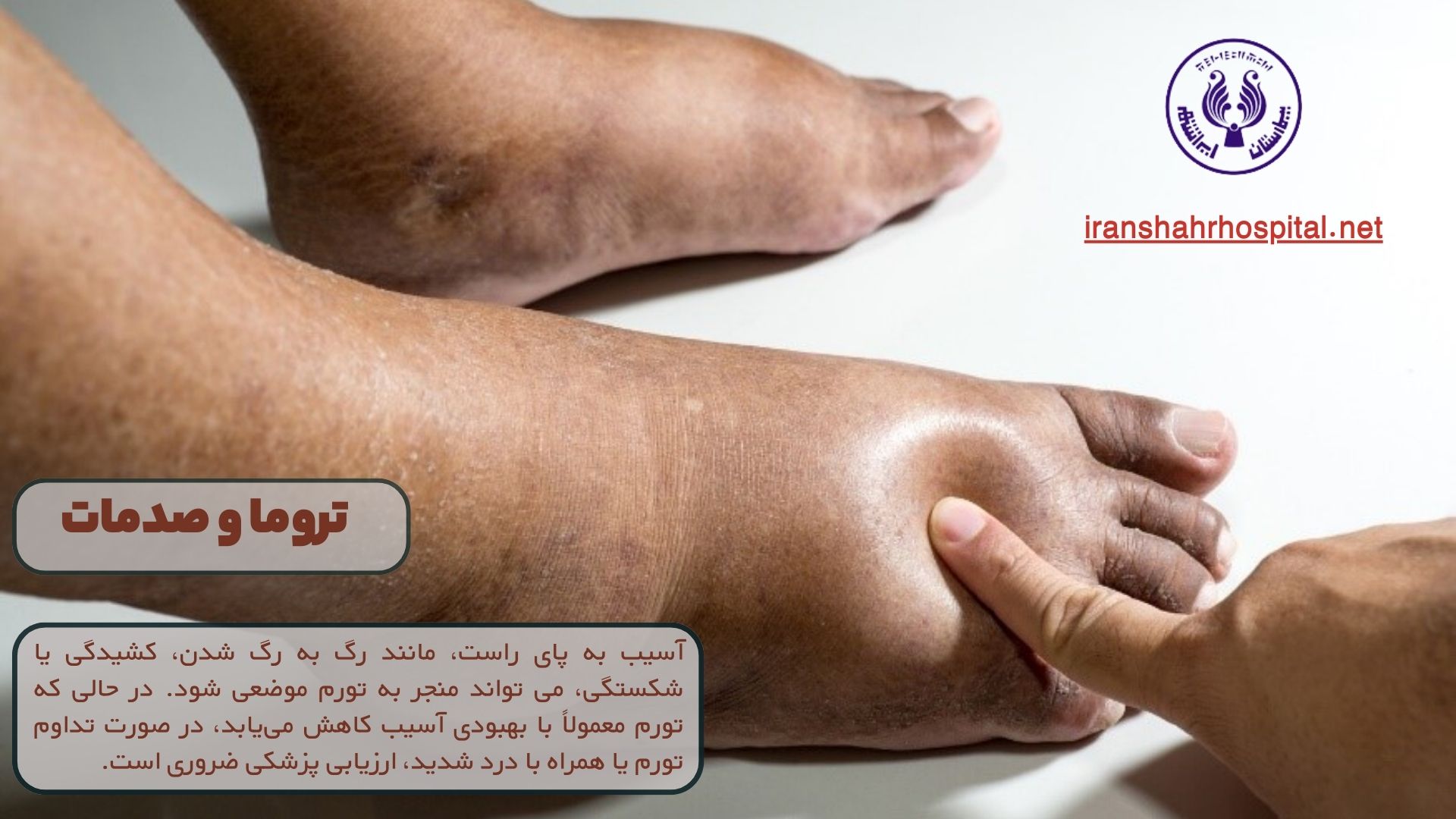 علت ورم پای راست چیست: تروما و صدمات