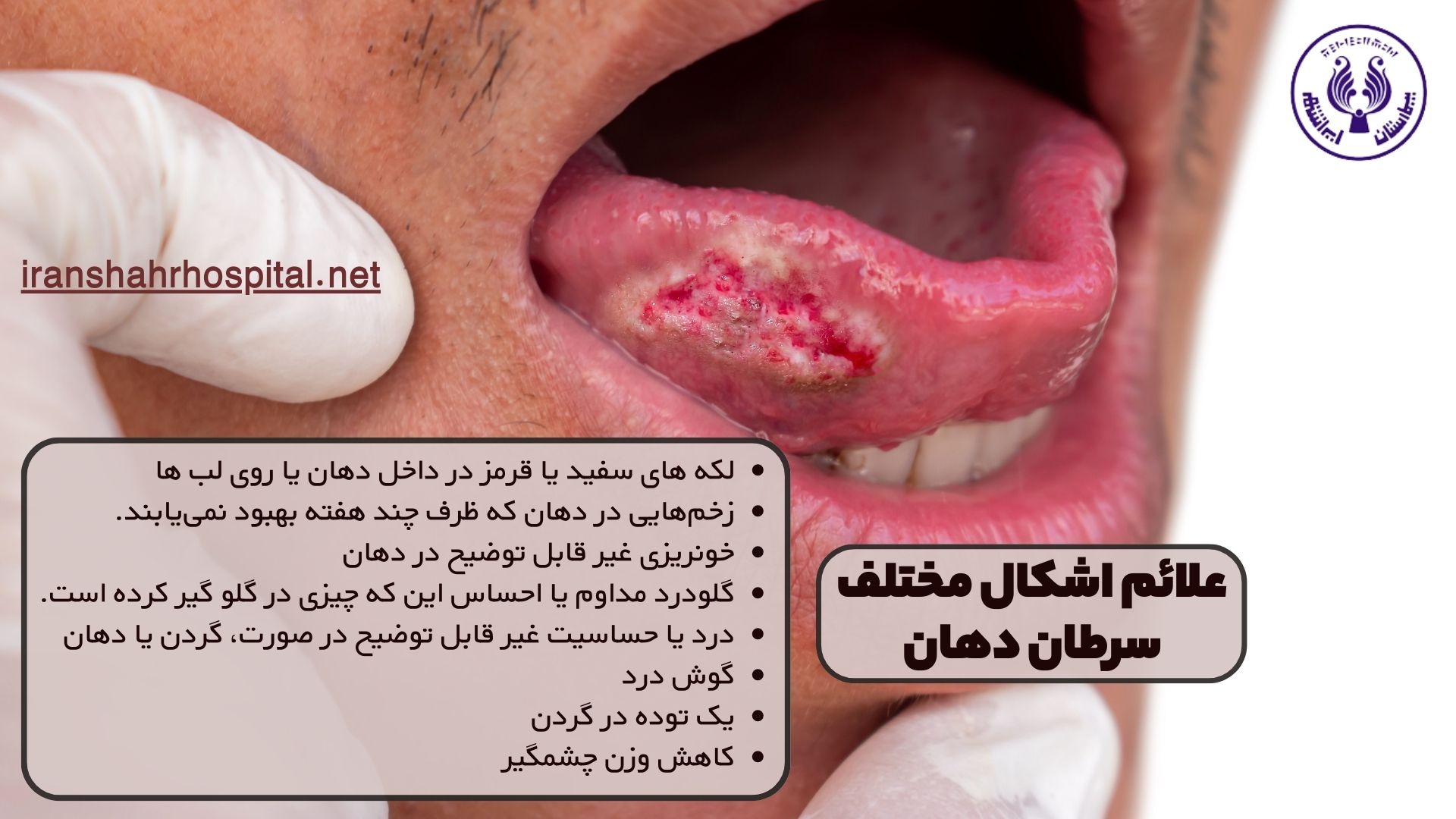 علائم اشکال مختلف سرطان دهان