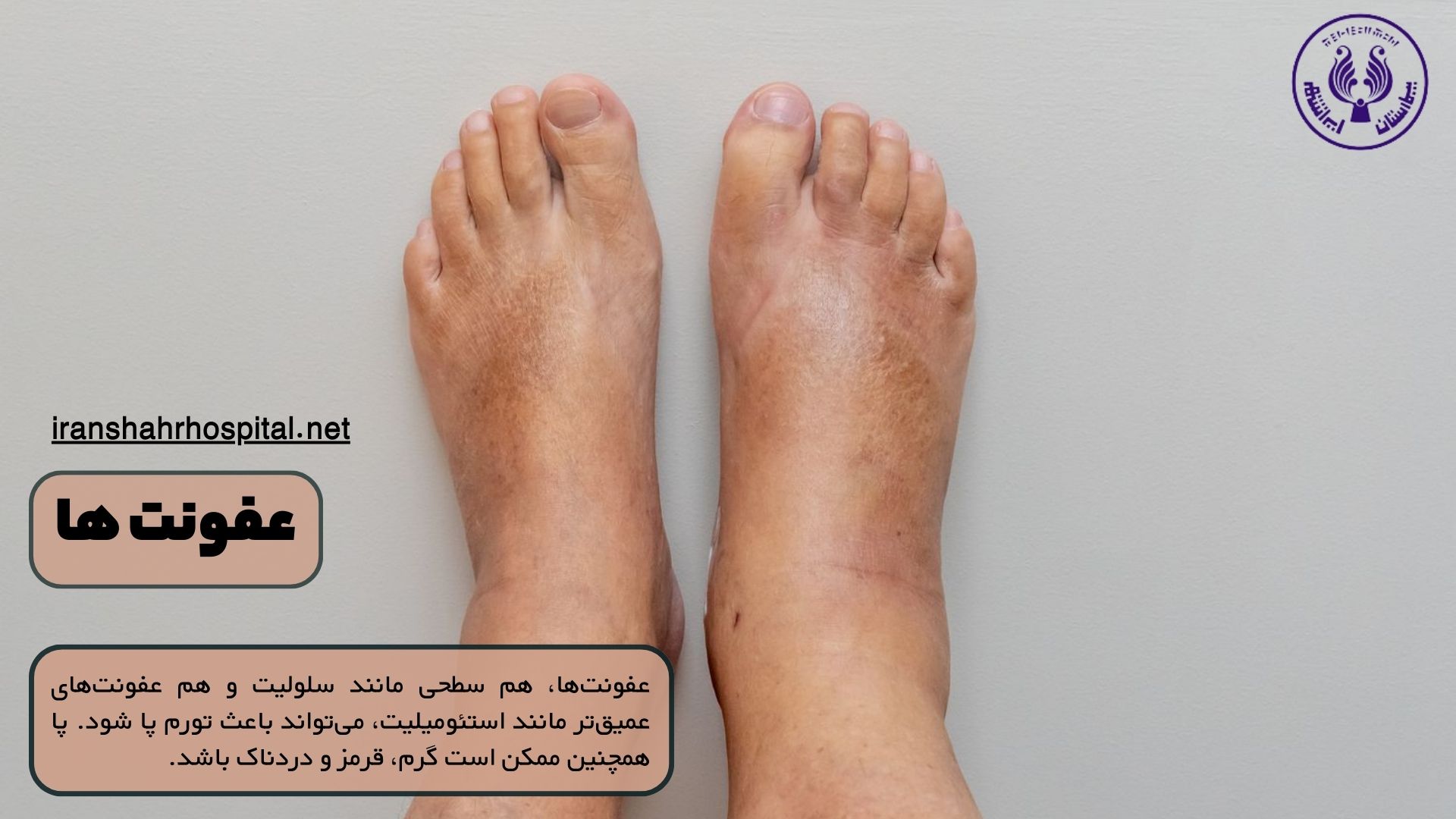 علت ورم پای راست چیست: عفونت ها